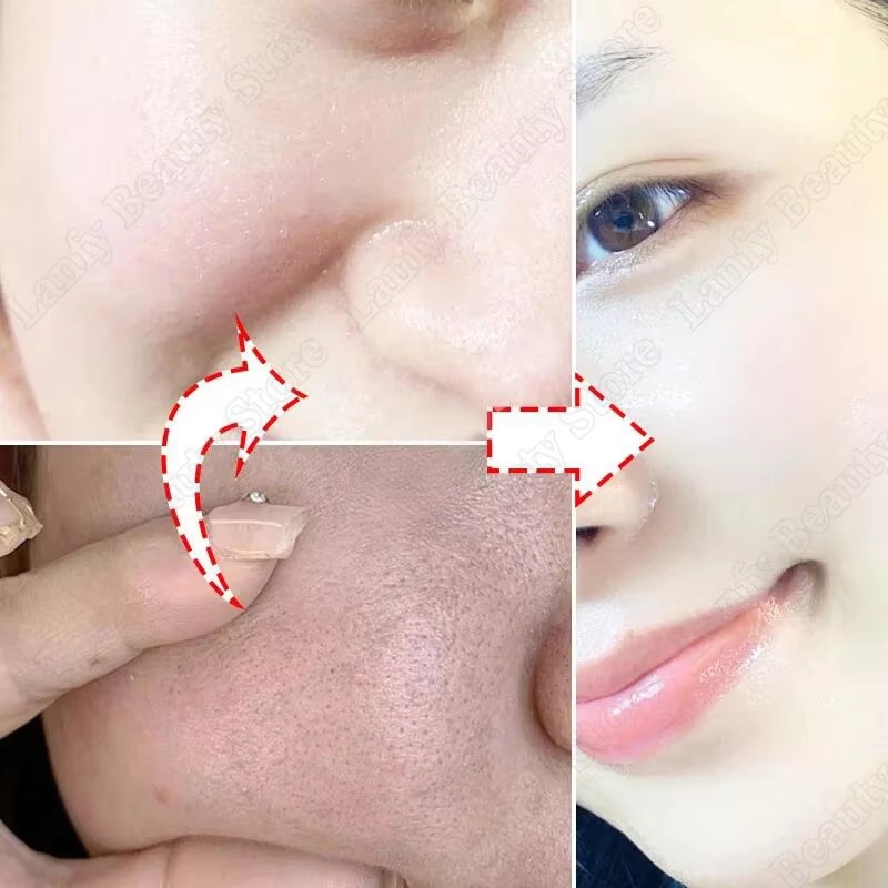 Krem z kwasem salicylowym do o – Salicylic Acid Blackhead Remover recenzja i cena