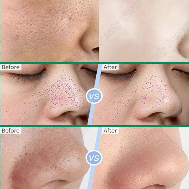 Krem z kwasem salicylowym do o – Salicylic Acid Blackhead Remover recenzja i cena
